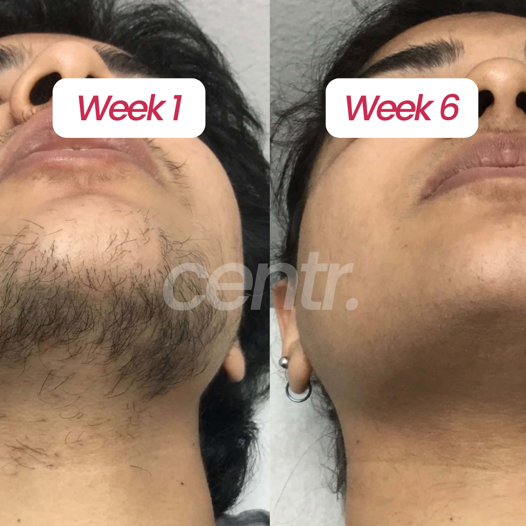 Centr PCOS Hair Removal Serum