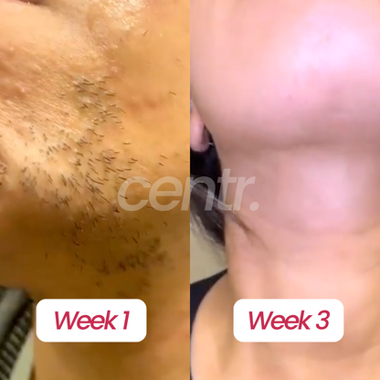 Centr PCOS Hair Removal Serum