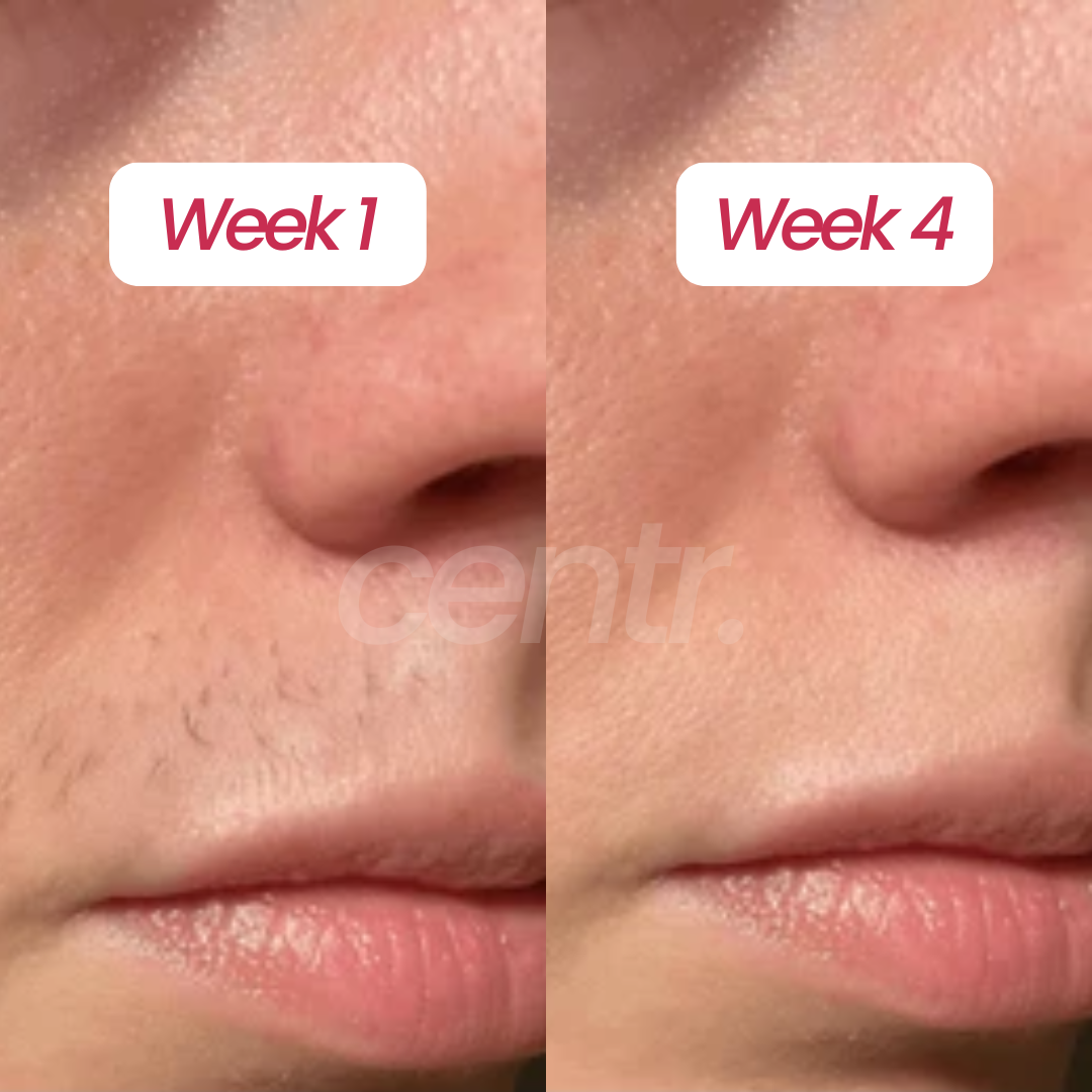 Centr PCOS Hair Removal Serum